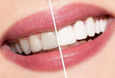 أخطاء العناية بالأسنان مسئولة عن اصفرارها