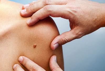 حل جديد لاكتشاف سرطان الجلد مبكرا