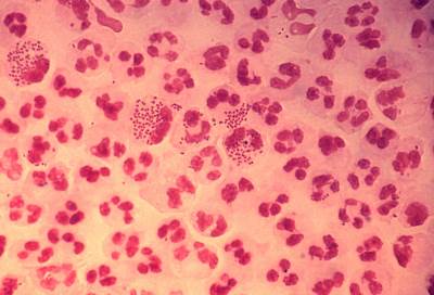 علماء أمريكيين على وشك الانتهاء من تطوير لقاح لعلاج مرض السيلان