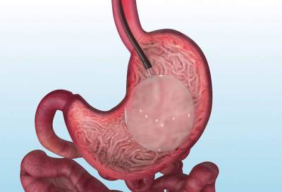 بالونة المعدة .. هل هي علاج آمن للسمنة؟