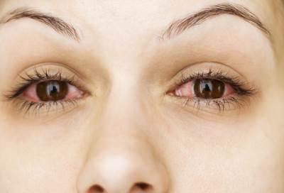 إذا كنت تعانى من احمرار العينين إليك طرق التخلص منها