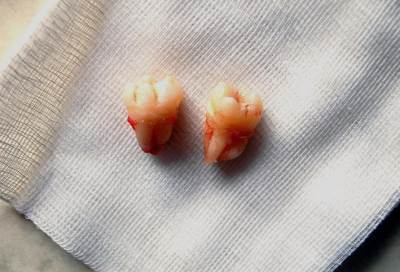 تعرفي على تأثير خلع ضرس العقل