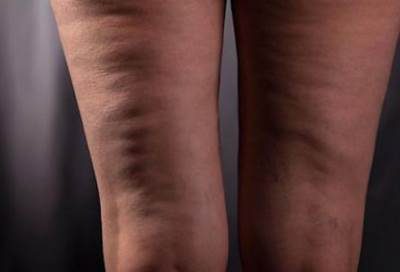 الأطعمة التي تساعد على الحد من السيلوليت