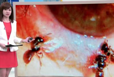 بالفيديو .. العثور على 4 نحلات داخل عين امرأة!