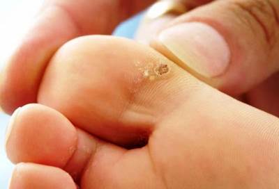 تعرفي على أسباب ظهور عين السمكة وكيفية مواجهتها