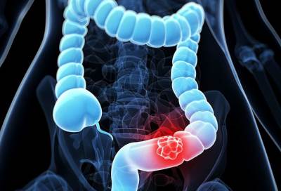 هذه الأطعمة تقلل خطر الإصابة بسرطان القولون