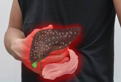 الصحة العالمية ترفع شعار "الاستثمار في القضاء على التهاب الكبد"