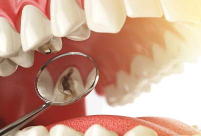 ابتكار لقاح مضاد لتسوس الأسنان