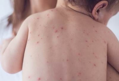 الأطفال سيموتون إذا لم نسيطر على الحصبة