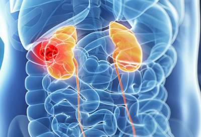 أسباب وراء الإصابة بسرطان الكلى .. تعرفي عليها