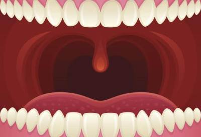 كيف تعالج حروق سقف الحلق البسيطة؟