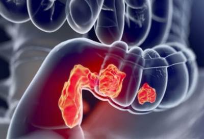 هل الحليب يسبب سرطان القولون؟