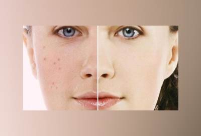 العلاجات المنزلية للتخلص من البقع الداكنة