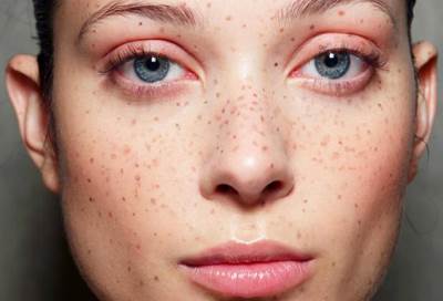 لماذا تظهر بقع بنية على الوجه واليدين مع التقدم فى العمر؟