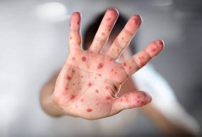  117 مليون طفل يواجهون خطر الإصابة بالحصبة بسبب كورونا