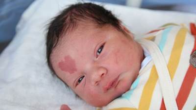 5 أمراض جلدية تصيب الأطفال .. تعرفي عليهم