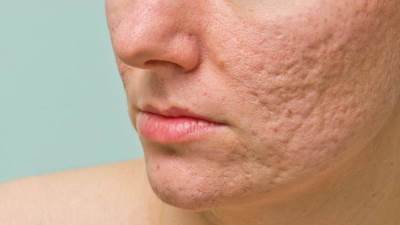 وصفة لـلتخلص من آثار حب الشباب .. تعرفي عليها