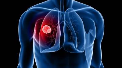 اسباب واعراض سرطان الرئة المتقدمة وعلاجها