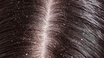 وصفات لعلاج قشرة الرأس .. تعرفي عليها