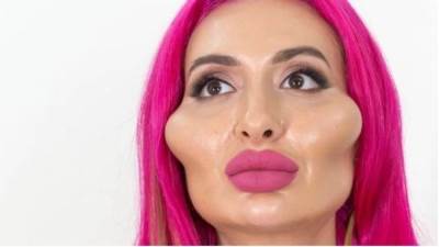 شاهد .. صاحبة أكبر خدود في العالم .. بقيت "باربي" بـ عملية "البوتكس"