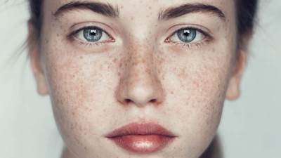 ما الذي يحاول النمش الموجود على بشرتك إخبارك به؟