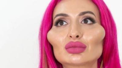 صاحبة أكبر خدود في العالم تُثير الجدل بصورتها الحقيقيه