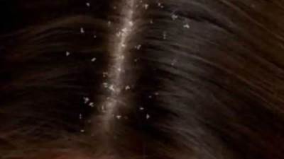 أسهل طريقة للقضاء على قشرة الشعر بثمن رخيص