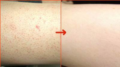 كيف تتخلصي من شعر تحت الجلد في الساقين؟