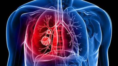 قبل انتشاره بالجسد.. أعراض بسيطة تدل على اصابتك بسرطان الرئه