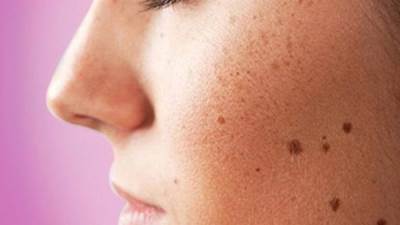 أساليب بسيطة للوقاية من ظهور البقع الداكنة .. تعرفي عليها