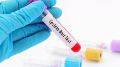 فيروس "إبشتاين بار"؟ اعرف أعراضه وعلاقته بكورونا