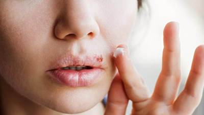  أعراض وأسباب وطرق الوقاية من قرح الفم 