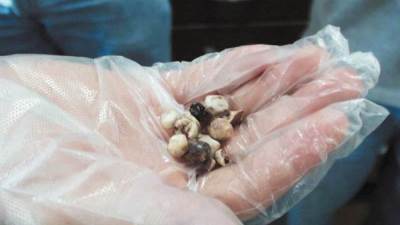 هؤلاء الأشخاص الأكثر عرضة للإصابة بحصوات المرارة