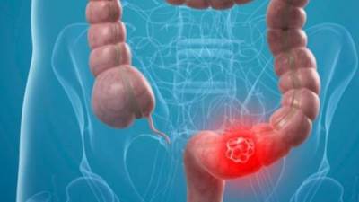 ما هو النظام الغذائي المناسب لمرضى سرطان القولون ؟