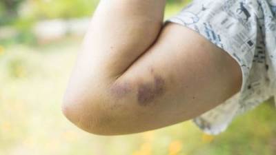 لماذا تظهر بقع زرقاء على جسدك؟