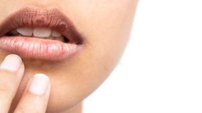 الصبار والشاي الأخضر.. أبرز مكونات لعلاج تشقق الشفاه 