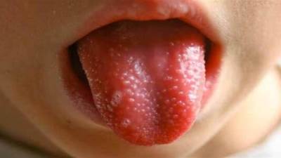  لماذا تظهر حبوب حمراء على لسان الأطفال؟