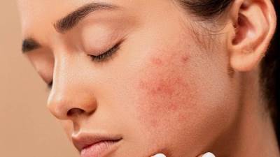 وصفات طبيعية لمحاربة الكلف.. جربيها ولن تندمي