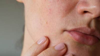 وصفة طبيعية هندية لعلاج مسام البشرة الواسعة