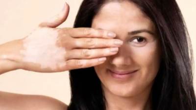 بارقة أمل لمرضى البهاق.. كريم طبي يعيد الجلد لطبيعته