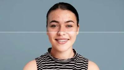 حمض اللينولييك.. علاج ثوري جديد لحب الشباب