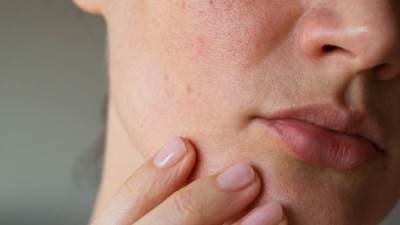 علاج تهيج البشرة وأسبابه