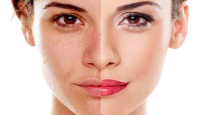 كيف تتخلصين من الكلف حتى لو كان قديمًا بطرق طبيعية؟