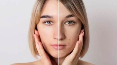 8 حلول جذريّة للقضاء على مشكلة توسّع المسام