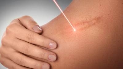 كيف تجري عملية علاج التصبغات والبقع البنية بالليزر؟