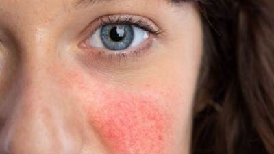 دراسة تكتشف سببا محتملاً لإصابة النساء بمرض الذئبة